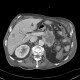 Recurrence of renal cell carcinoma, hypervascular metastases in liver and retroperitoneum: CT - Computed tomography